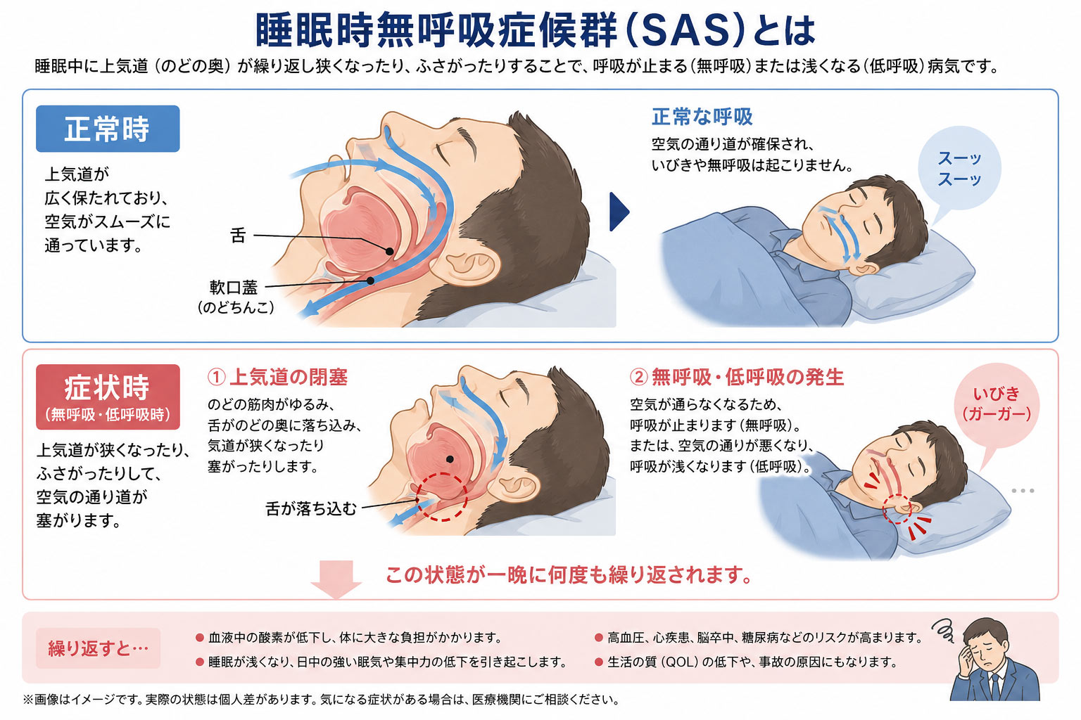 睡眠時無呼吸症候群（SAS）とは
